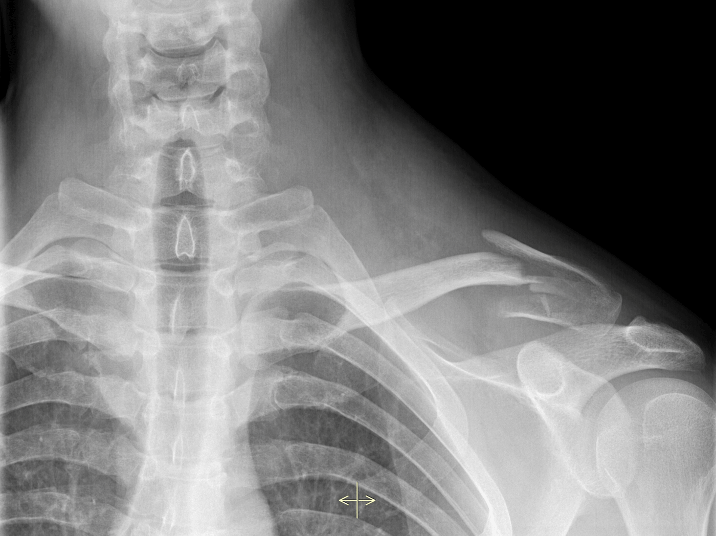 Fractures & Trauma